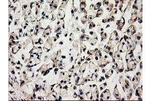 Immunohistochemical staining of paraffin-embedded Adenocarcinoma of Human colon tissue using anti-ACOT12 mouse monoclonal antibody.