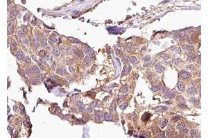 ABIN6269013 at 1/100 staining Human breast cancer tissue by IHC-P.