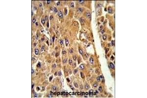 Formalin-fixed and paraffin-embedded human hepatocarcinoma reacted with CYP3A5 Antibody (Center) (ABIN652394 and ABIN2841919) , which was peroxidase-conjugated to the secondary antibody, followed by DAB staining. (CYP3A5 Antikörper  (AA 186-218))