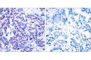 Immunohistochemistry analysis of paraffin-embedded human breast carcinoma, using JunD (Phospho-Ser255) Antibody.