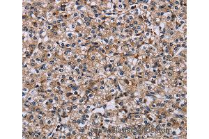 Immunohistochemistry of Human prostate cancer using IPO4 Polyclonal Antibody at dilution of 1:50 (Importin 4 Antikörper)