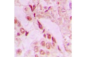 Immunohistochemical analysis of DJ-1 staining in human lung cancer formalin fixed paraffin embedded tissue section. (PARK7/DJ1 Antikörper  (Center))