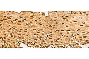 Immunohistochemistry of paraffin-embedded Human cervical cancer tissue using UBLCP1 Polyclonal Antibody at dilution of 1:80(x200) (UBLCP1 Antikörper)