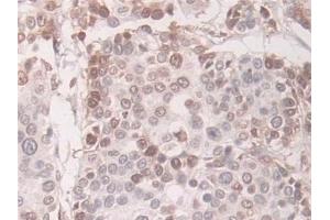 Detection of TAGLN in Human Prostate cancer Tissue using Polyclonal Antibody to Transgelin (TAGLN) (Transgelin Antikörper  (AA 1-201))