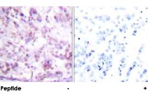 Immunohistochemical analysis of paraffin-embedded human breast carcinoma tissue using MYB polyclonal antibody . (MYB Antikörper  (Ser12))