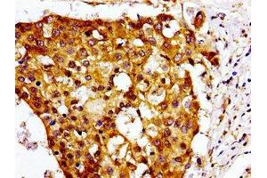 Immunohistochemistry of paraffin-embedded human breast cancer using ABIN7147549 at dilution of 1:100