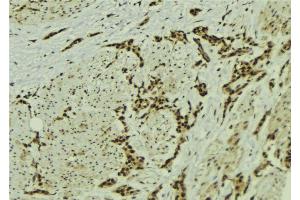 ABIN6273056 at 1/100 staining Human breast cancer tissue by IHC-P. (MMS19 Antikörper  (Internal Region))