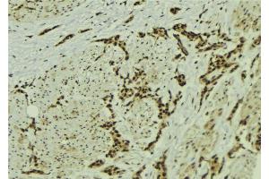ABIN6273056 at 1/100 staining Human breast cancer tissue by IHC-P. (MMS19 Antikörper  (Internal Region))