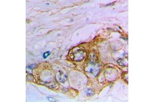 Immunohistochemical analysis of MUC16 staining in human bladder cancer formalin fixed paraffin embedded tissue section.