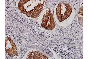 Immunoperoxidase of monoclonal antibody to SLC11A2 on formalin-fixed paraffin-embedded human endometrium cancer. (SLC11A2 Antikörper  (AA 1-65))