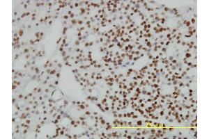 Immunoperoxidase of monoclonal antibody to ZNF143 on formalin-fixed paraffin-embedded human ovary, clear cell carcinoma tissue.