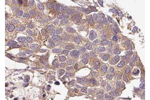ABIN6267636 at 1/100 staining human breast carcinoma tissue sections by IHC-P. (G3BP1 Antikörper  (pSer232))