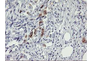 Immunohistochemical staining of paraffin-embedded Carcinoma of Human pancreas tissue using anti-SERPINB2 mouse monoclonal antibody. (SERPINB2 Antikörper)