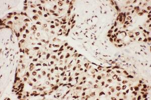 Anti-ALOX5 Picoband antibody,  IHC(P): Human Mammary Cancer Tissue
