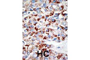 Formalin-fixed and paraffin-embedded human hepatocellular carcinoma tissue reacted with UBA3 polyclonal antibody  , which was peroxidase-conjugated to the secondary antibody, followed by DAB staining. (UBA3 Antikörper  (C-Term))