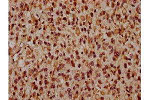 IHC image of ABIN7165222 diluted at 1:1600 and staining in paraffin-embedded human glioma performed on a Leica BondTM system. (CRB2 Antikörper  (AA 253-483))