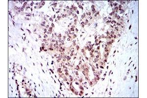 Immunohistochemical analysis of paraffin-embedded ovarian cancer tissues using SKP1 mouse mAb with DAB staining.