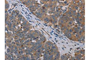 The image on the left is immunohistochemistry of paraffin-embedded Human ovarian cancer tissue using ABIN7191748(OTOR Antibody) at dilution 1/30, on the right is treated with synthetic peptide. (Otoraplin Antikörper)