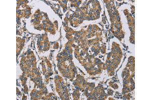 Immunohistochemistry of Human cervical cancer using HDAC6 Polyclonal Antibody at dilution of 1:50 (HDAC6 Antikörper)