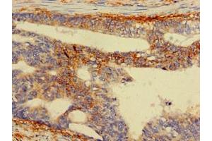 Immunohistochemistry of paraffin-embedded human colon cancer using ABIN7142563 at dilution of 1:100 (RPS5 Antikörper  (AA 1-204))