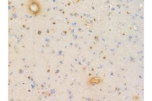 ABIN6256636 and ABIN6267635 at 1/100 staining human glioblastoma by IHC-P.