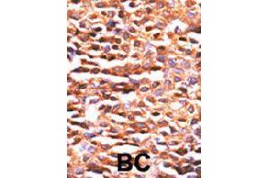 Formalin-fixed and paraffin-embedded human breast cancer tissue reacted with PPP2CA polyclonal antibody  , which was peroxidase-conjugated to the secondary antibody, followed by DAB staining. (PPP2CA Antikörper  (N-Term))