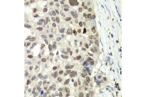 Immunohistochemistry of paraffin-embedded human esophageal cancer using E2F6 antibody. (E2F6 Antikörper)