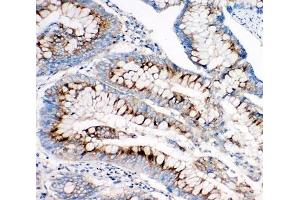 IHC-P: IGF2R antibody testing of human intestine cancer tissue (IGF2R Antikörper  (C-Term))