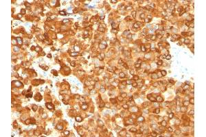 Formalin-fixed, paraffin-embedded human Melanoma stained with gp100 Mouse Monoclonal Antibody (PMEL/783). (Melanoma gp100 Antikörper)