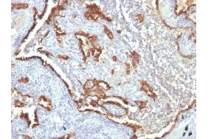 Formalin-fixed, paraffin-embedded human Lung Carcinoma stained with Cytokeratin 7 Monoclonal Antibody (KRT7/760 + OV-TL12/30) (Cytokeratin 7 Antikörper)