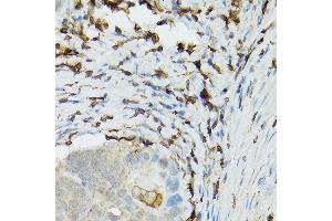 Immunohistochemistry of paraffin-embedded human colon carcinoma using TLR1 Rabbit pAb (ABIN3023654, ABIN3023655, ABIN3023656 and ABIN6214092) at dilution of 1:100 (40x lens).