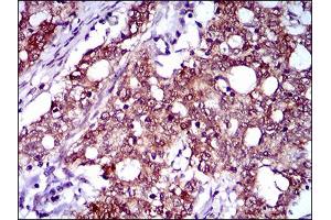 Immunohistochemical analysis of paraffin-embedded cervical cancer tissues using CFLAR mouse mAb with DAB staining.