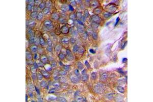 Immunohistochemical analysis of MMP10 staining in human prostate cancer formalin fixed paraffin embedded tissue section. (MMP10 Antikörper  (C-Term))