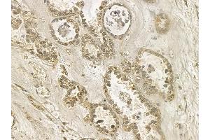 ANP32E Mouse Monoclonal Antibody at 1/100 staining human ovarian cancer by IHC-P. (ANP32E Antikörper)