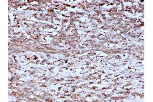 Formalin-fixed, paraffin-embedded human Hepatocellular Carcinoma stained with Cathepsin K Mouse Monoclonal Antibody (CTSK/2793).