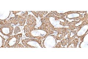 Immunohistochemistry of paraffin-embedded Human thyroid cancer tissue using RNF111 Polyclonal Antibody at dilution of 1:50(x200) (RNF111 Antikörper)
