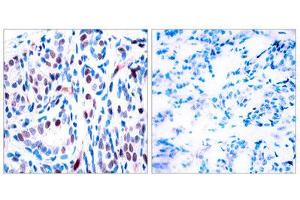 Immunohistochemistry (IHC) image for anti-Signal Transducer and Activator of Transcription 3 (Acute-Phase Response Factor) (STAT3) (pTyr705) antibody (ABIN1847535) (STAT3 Antikörper  (pTyr705))