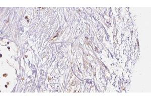 ABIN6273048 at 1/100 staining Human liver cancer tissue by IHC-P. (HLA-F Antikörper)
