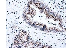 Immunohistochemical staining of paraffin-embedded Adenocarcinoma of colon tissue using anti-KIAA1609 mouse monoclonal antibody. (KIAA1609 Antikörper)
