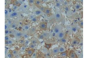 Detection of TNFR1 in Human Liver cancer Tissue using Polyclonal Antibody to Tumor Necrosis Factor Receptor 1 (TNFR1) (TNFRSF1A Antikörper  (AA 60-236))