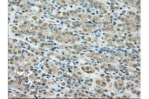 Immunohistochemical staining of paraffin-embedded Carcinoma of thyroid tissue using anti-SSBmouse monoclonal antibody. (SSB Antikörper)