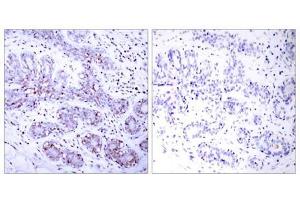 Immunohistochemical analysis of paraffin-embedded human breast carcinoma tissue using STAT4 (Ab-693) antibody (E021047). (STAT4 Antikörper)