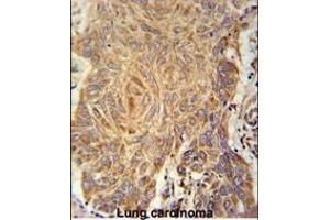 PCYXL Antibody (C-term) (ABIN651800 and ABIN2840404) immunohistochemistry analysis in formalin fixed and paraffin embedded human Lung carcinoma followed by peroxidase conjugation of the secondary antibody and DAB staining. (PCYOX1L Antikörper  (C-Term))