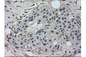 Immunohistochemical staining of paraffin-embedded Carcinoma of kidney tissue using anti-NEK6mouse monoclonal antibody.
