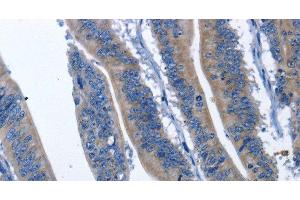 Immunohistochemistry of paraffin-embedded Human colon cancer using HSF27 Polyclonal Antibody at dilution of 1:60 (CDK5RAP3 Antikörper)