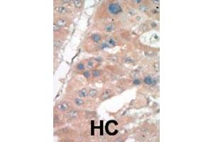 Formalin-fixed and paraffin-embedded human cancer tissue reacted with the primary antibody, which was peroxidase-conjugated to the secondary antibody, followed by DAB staining. (p21 Antikörper  (C-Term))
