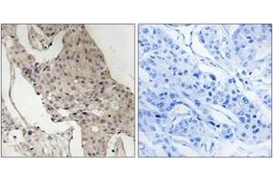 Immunohistochemistry analysis of paraffin-embedded human breast carcinoma, using Gab2 (Phospho-Ser623) Antibody. (GAB2 Antikörper  (pSer623))