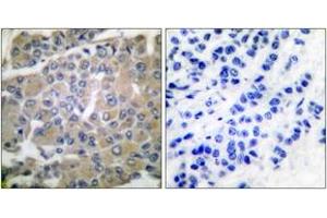 Immunohistochemistry analysis of paraffin-embedded human breast carcinoma tissue, using MMP-8 Antibody. (MMP8 Antikörper  (AA 418-467))