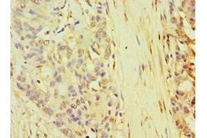 Immunohistochemistry of paraffin-embedded human endometrial cancer using ABIN7168268 at dilution of 1:100 (TARBP2 Antikörper  (AA 1-366))