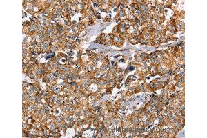 Immunohistochemistry of Human breast cancer using PPOX Polyclonal Antibody at dilution of 1:40